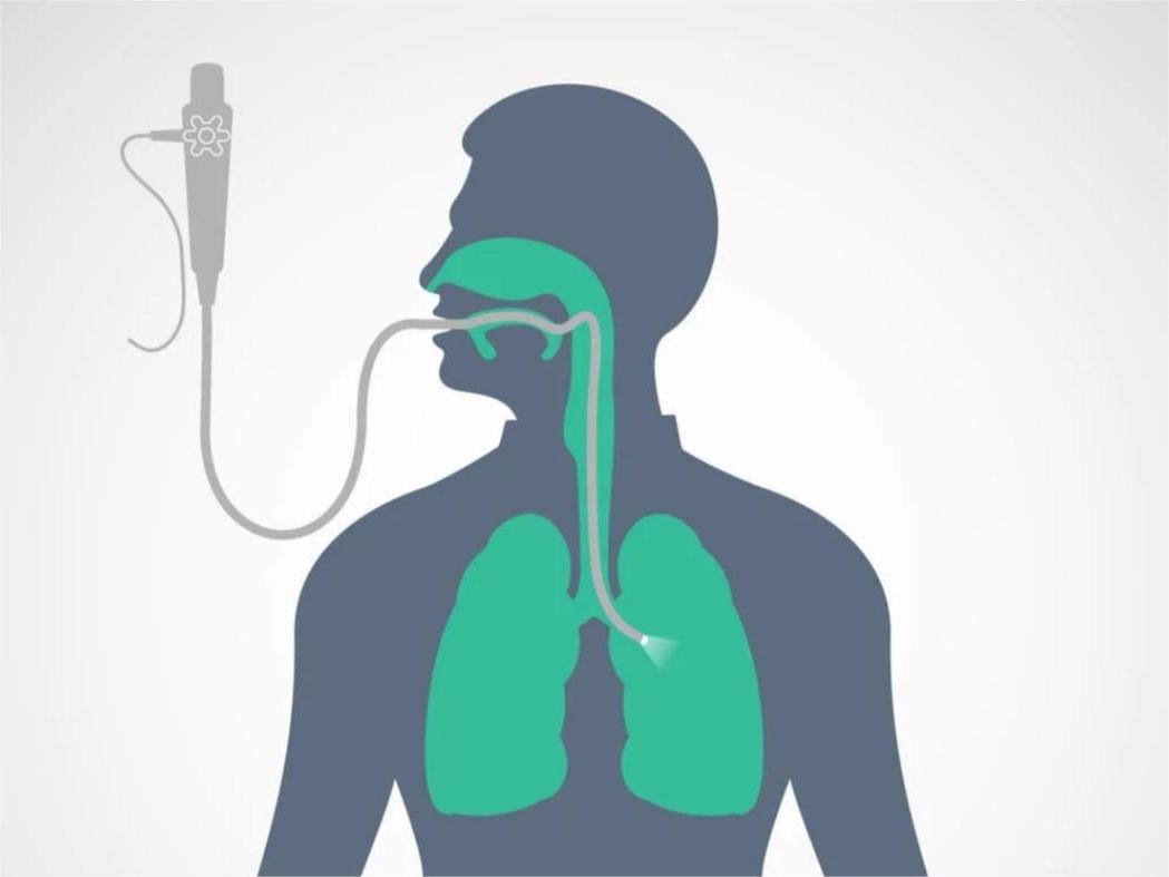 電子支氣管鏡在醫療實踐中的應用