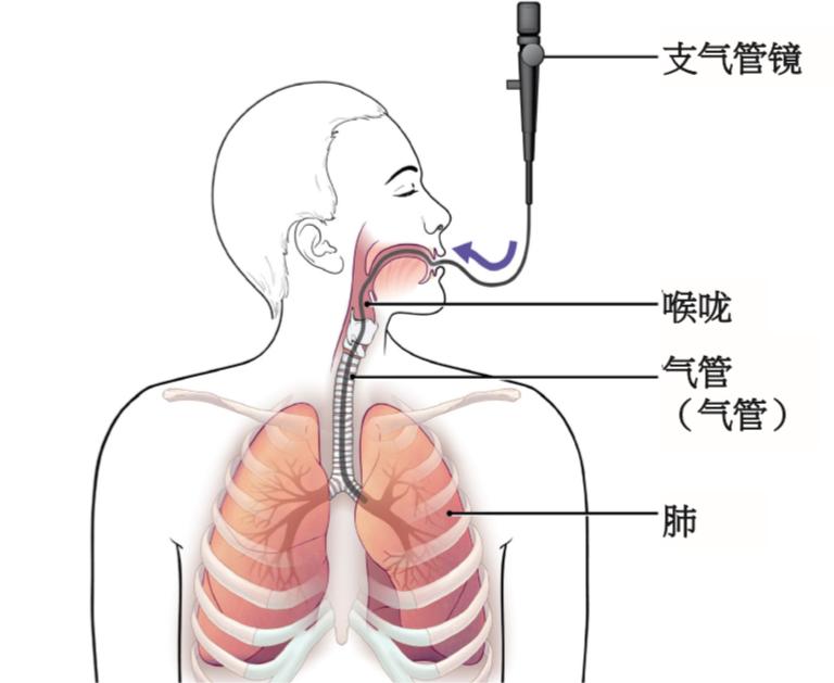 鼴鼠醫療視角下：頸椎固定患者可視喉鏡與纖支鏡氣管插管的比較